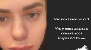 Анастасия Балинская: Дырка в спинке носа